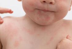 Comer para vivir: Alergias alimentarias en bebés