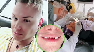 Carlos Cacho perdió tres dientes tras accidente: “El mango del timón de la moto me reventó el labio” | VIDEO