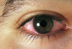 Casos de conjuntivitis aumentan en más de 50% en el verano