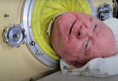 Paul Alexander, el hombre del ‘pulmón de acero’ murió a los 78 años de edad