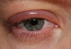 Cambio climático y el fenómeno del Niño aumentan las enfermedades oculares