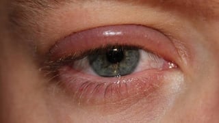 Cambio climático y el fenómeno del Niño aumentan las enfermedades oculares