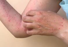 Viruela del mono: ¿Cómo prevenir el contagio?