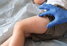 Lanzan alerta epidemiológica por más casos de sarampión