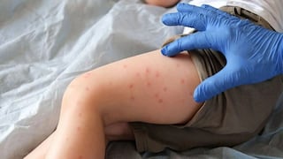 Lanzan alerta epidemiológica por más casos de sarampión