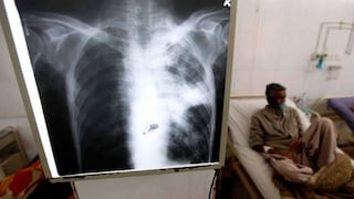 Tuberculosis en Perú: Pacientes reciben alimentos insuficientes por parte del Estado