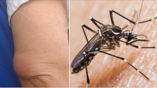 Callao: doctor fue a atender a paciente y sufrió picadura de mosquito aedes aegypti