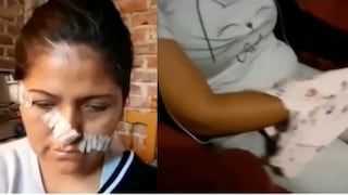 Barranca: mujer termina con la cara desfigurada tras agresión de sus vecinas