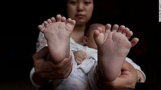 China: Nace niño con 31 dedos en manos y pies