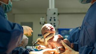 ¿Es la cesárea perjudicial para el bebé?