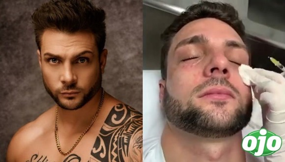 Instagram: Nicola Porcella se hizo otro 'retoquito' en el rostro - diario ojo