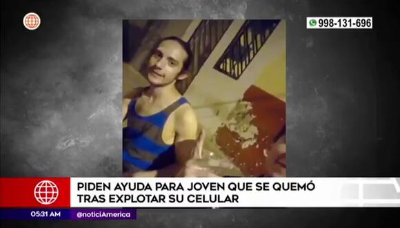 Surquillo: Joven sufre quemaduras al explotar su celular.