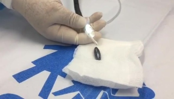 Huánuco: salvan vida de niño tras extraerle una piedra imantada del estómago