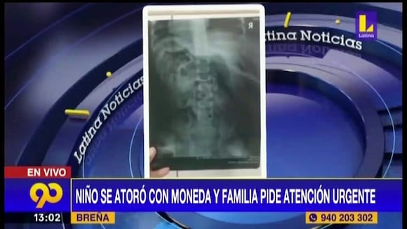 Breña: Niño de año y medio se atora con moneda | OJO