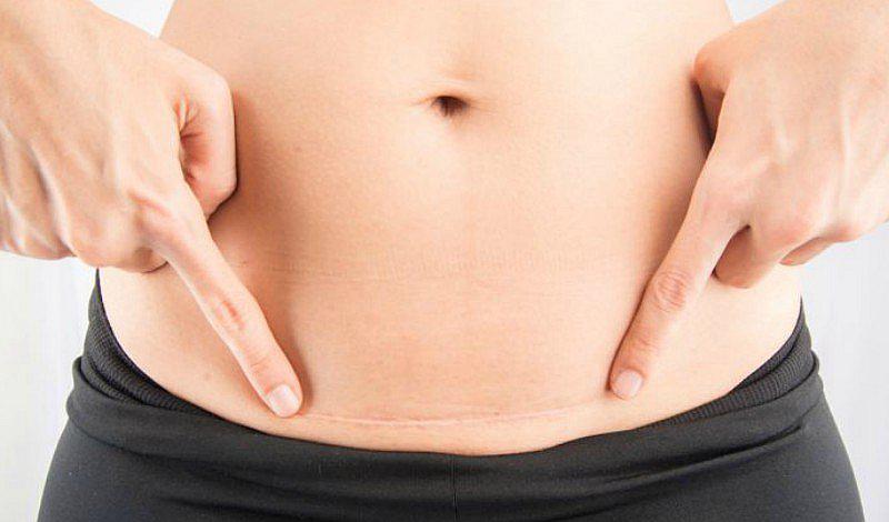 ¿Se practica la cesárea solo tres veces como máximo?