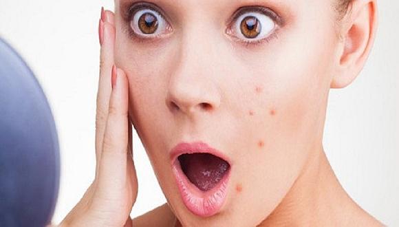 ¿Tienes acné? Descubre qué enfermedad puedes padecer por su ubicación