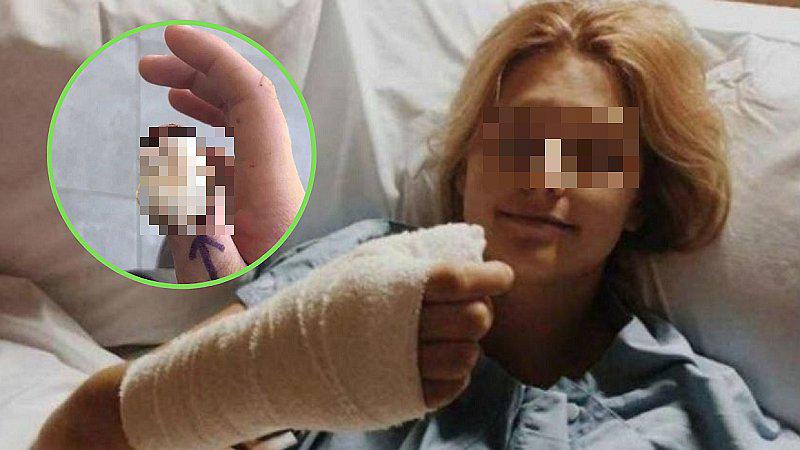 Médicos le cortan el dedo pulgar por su manía de comerse las uñas (FOTOS)