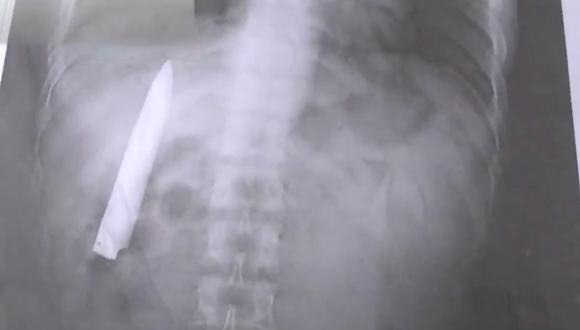 Ryan Tomao fue apuñalado en enero del aña pasado y los doctores que lo atendieron no se dieron cuenta que la hoja quedó al interior de su pecho. (Foto: Difusión)