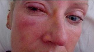 Mujer queda ciega por parásito que le "devoró" el ojo 